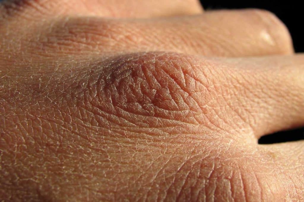 hand-cracks-from-dry-skin